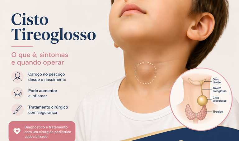 Cisto Tireoglosso: o que é, sintomas e quando operar